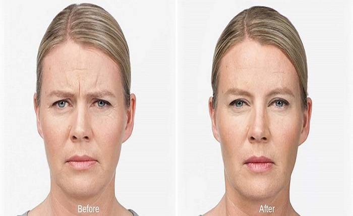 Botox For Wrinkles: What You Need To Know Before Getting Treatment?