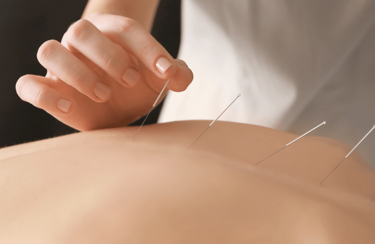 When to Consider Acupuncture as Part of Your Depression Treatment Plan